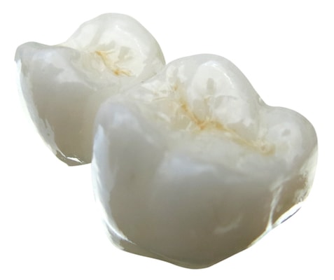 Equiva bridge with three artificial teeth in the row
