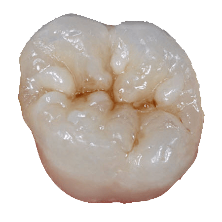 Close-up of a composite crown designed to match your teeth