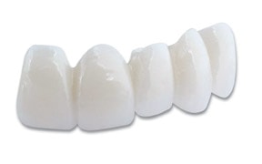 Radica temporary with five teeth in a white material